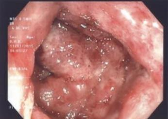 Before treatment